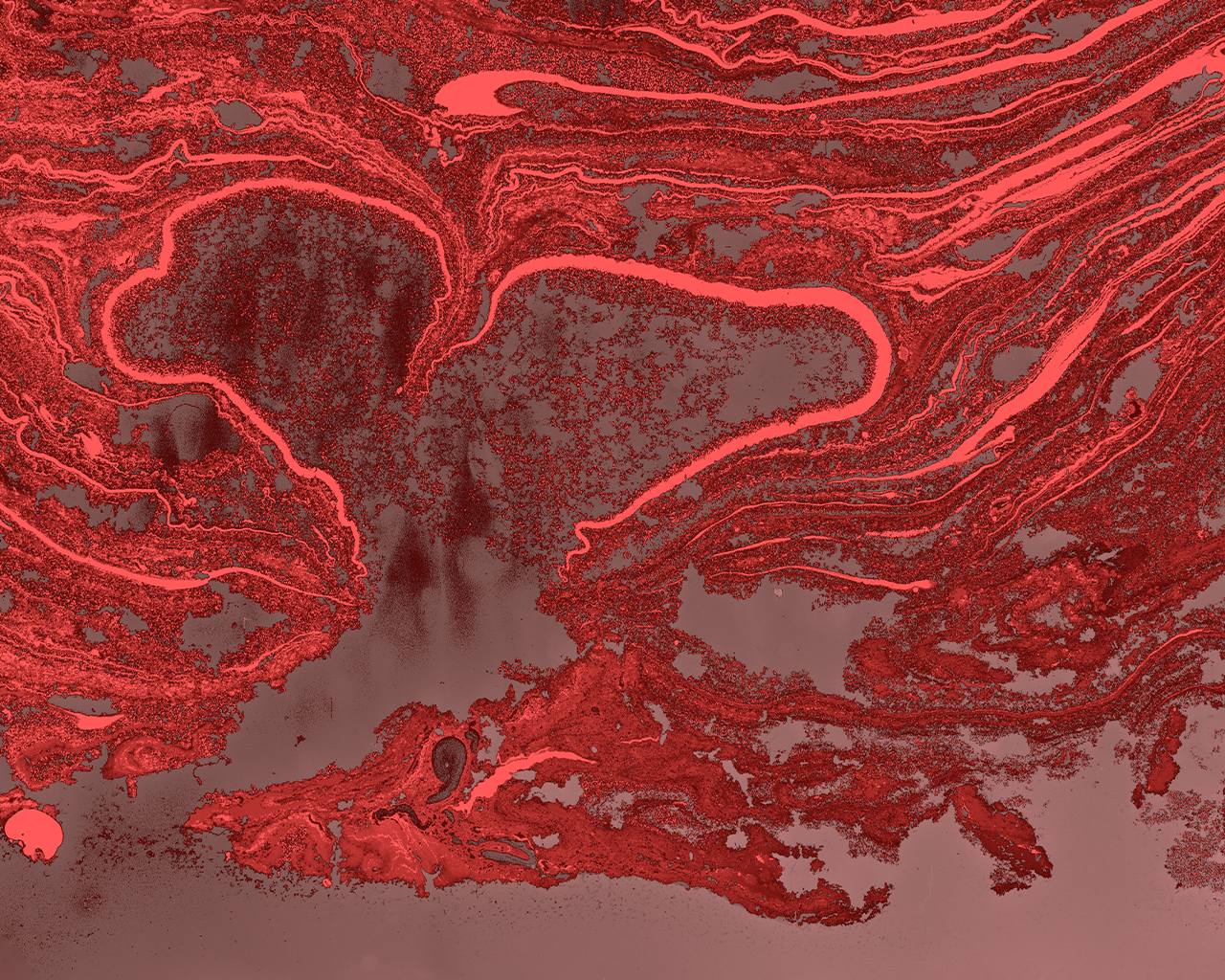 Il·lustració conceptual del remodelat vascular en les artèries del pulmó, emprada en la divulgació científica sobre la Hipertensió Arterial Pulmonar per Ferrer.