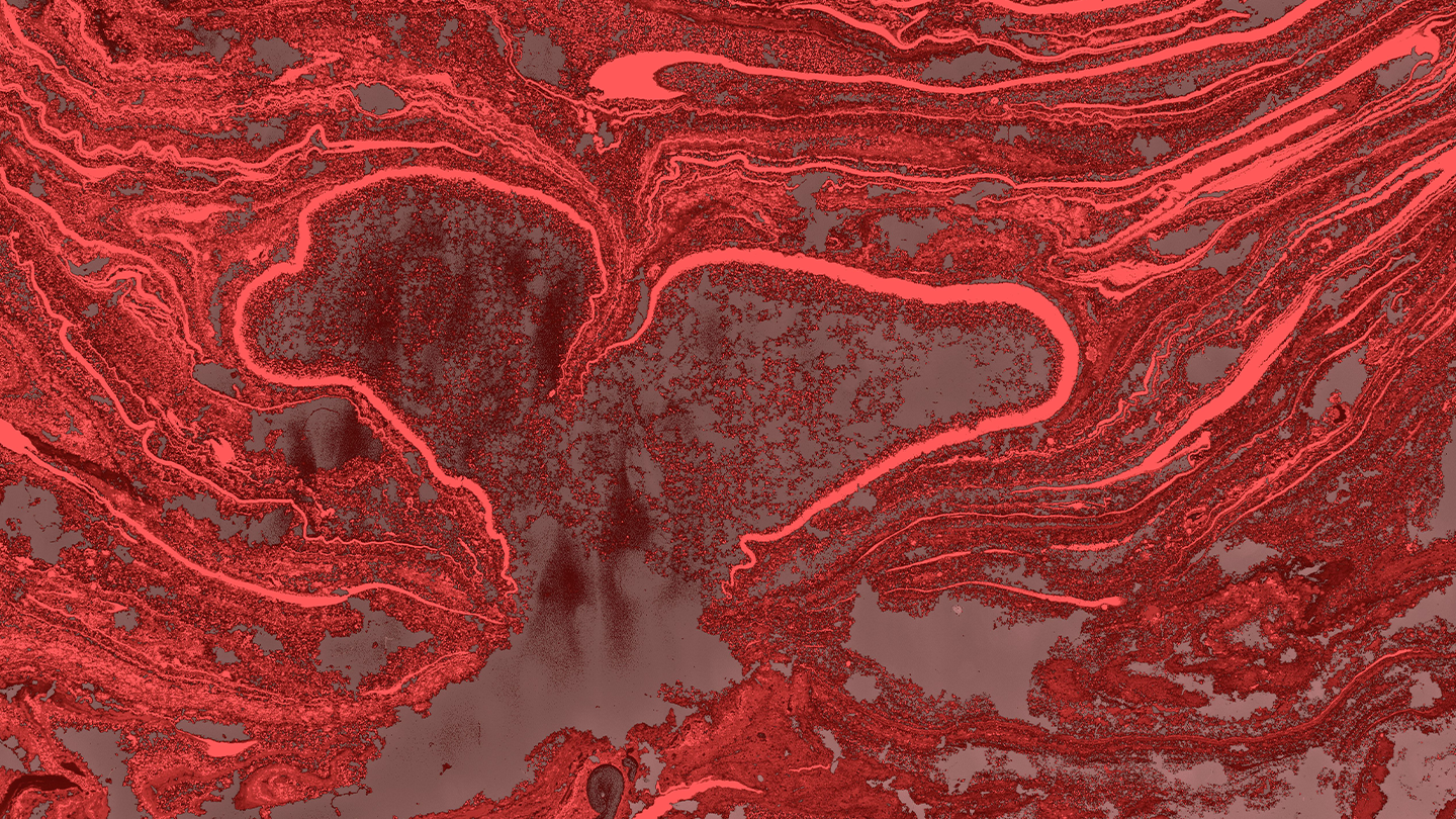 Conceptual illustration of vascular remodeling in the arteries of the lung, used in the scientific dissemination of Pulmonary Arterial Hypertension by Ferrer.