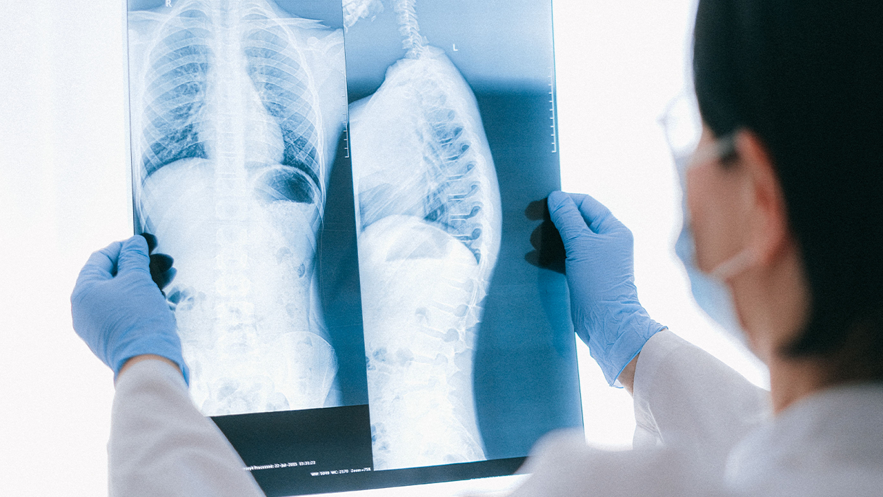 View from the shoulder of a medical professional wearing blue gloves and a mask analyzing a chest and spine X-ray against the light.