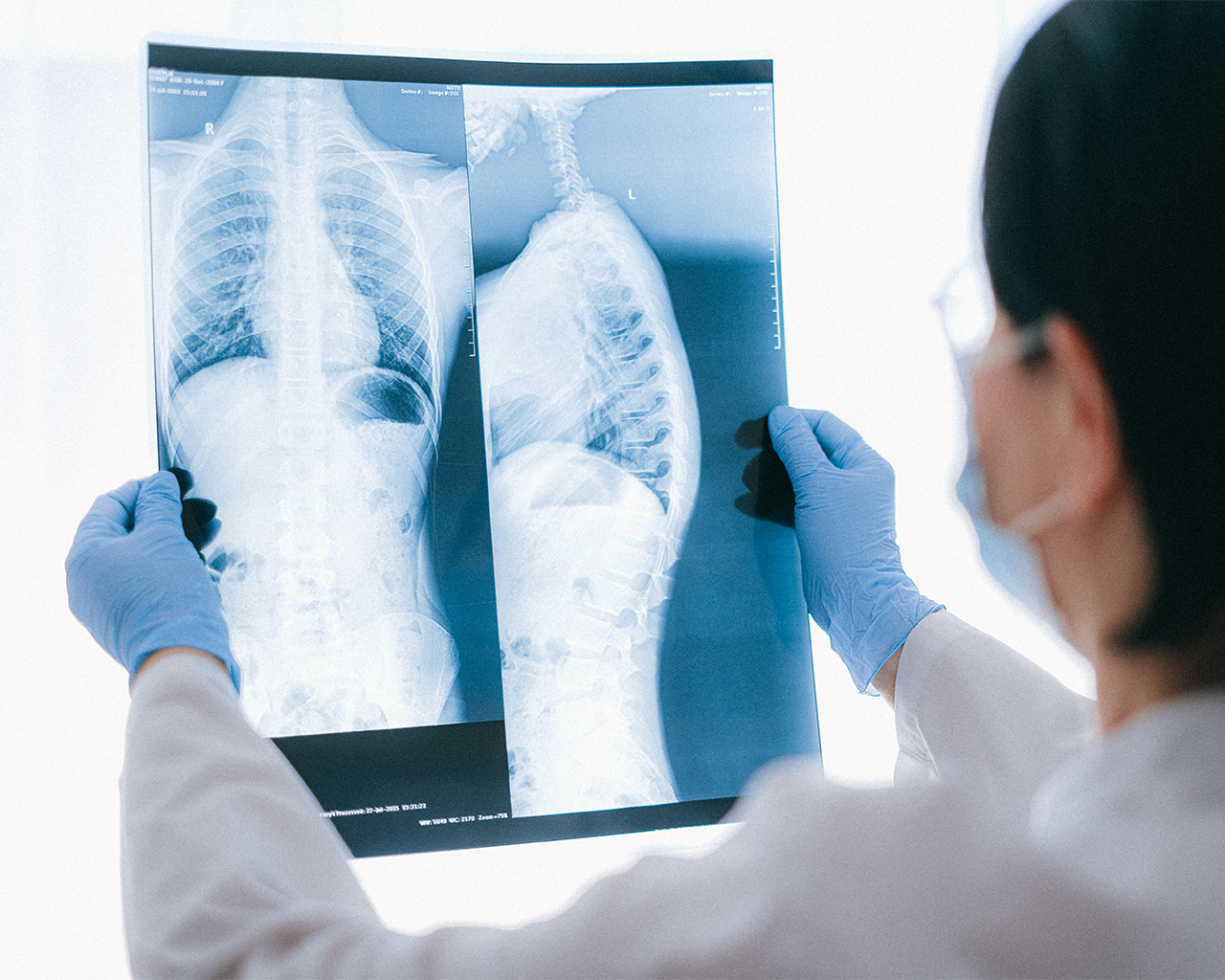View from the shoulder of a medical professional wearing blue gloves and a mask analyzing a chest and spine X-ray against the light.